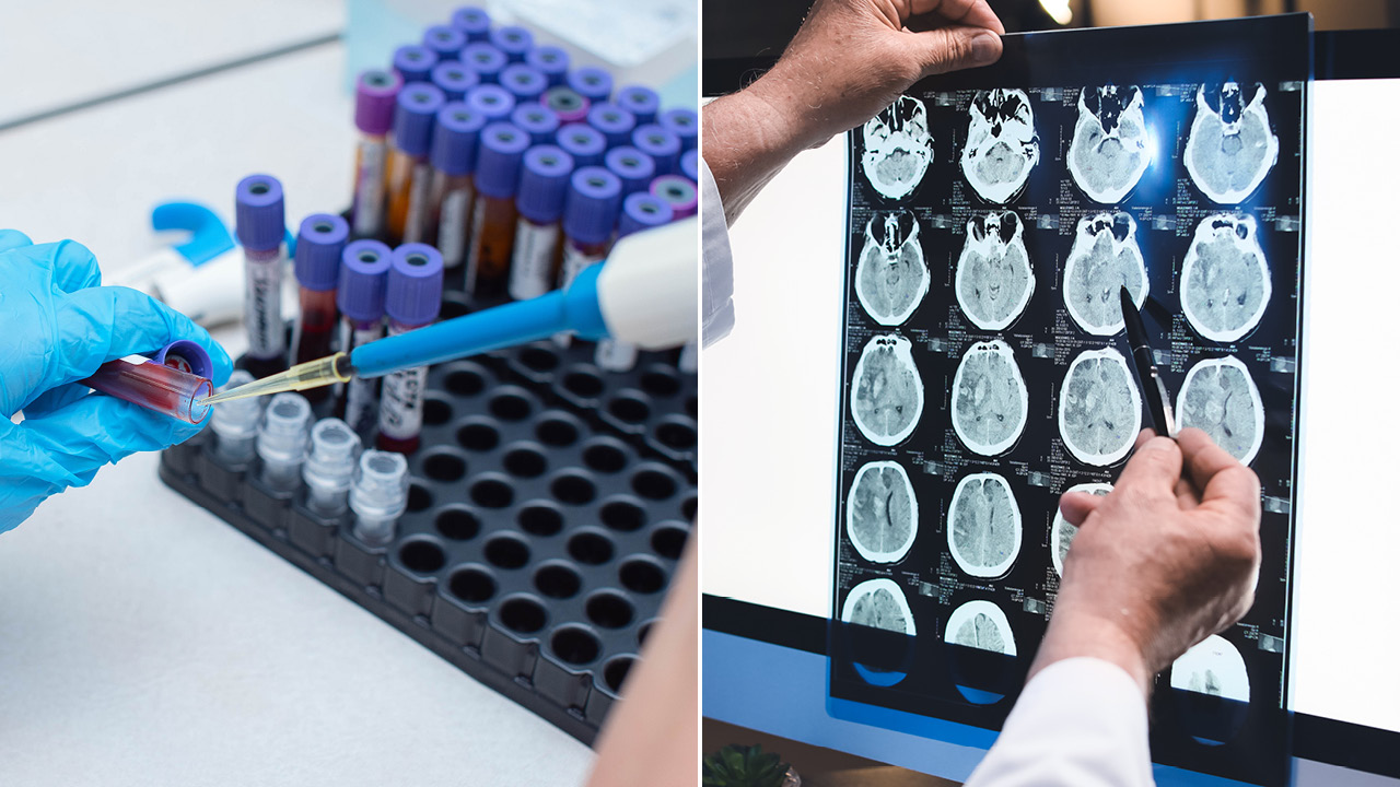 Left: gloved hand filling a test tube from a vial in a rack of samples; right: medical professional points at brain MRI images displayed on a lightbox.